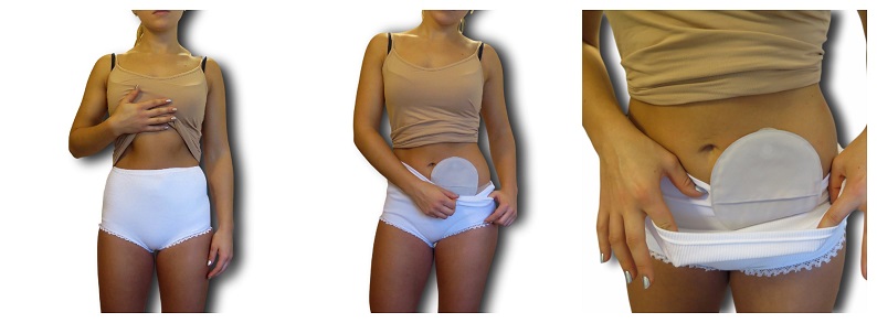 Ostomy Underwear: Woman